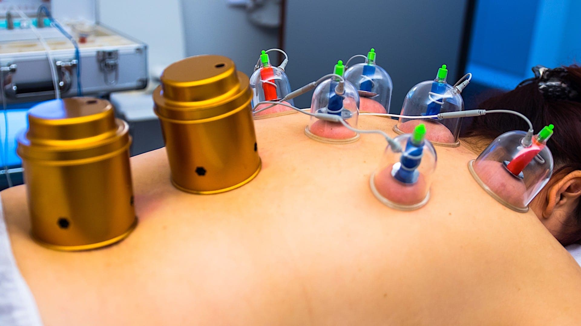 Cupping Specialist Quanjian Gezondheidscentrum Eindhoven