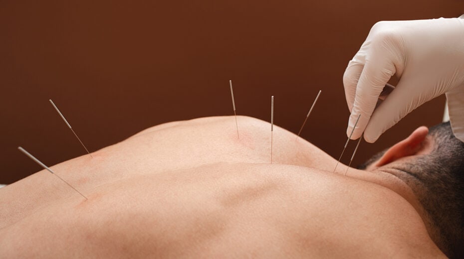 Acupunctuur behandeling met naalden in rug